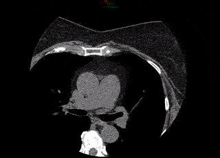 Escore de Cálcio Coronariano de Zero Imagem ilustrando exame de escore de cálcio coronariano com ausência de calcificações coronárias. Escore de cálcio de zero.