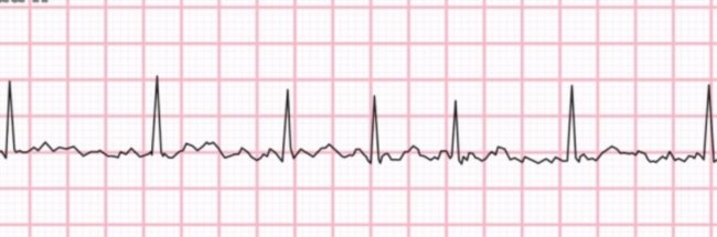 Flutter Atrial e Fibrilação Atrial: Entendendo essas Arritmias ...