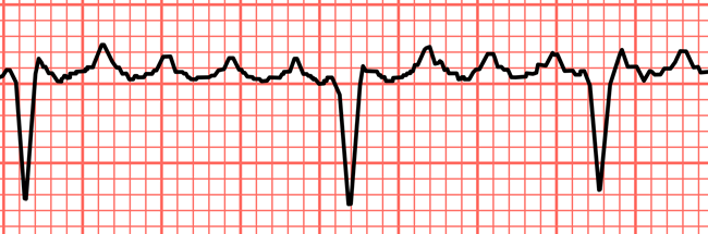 Flutter Atrial e Fibrilação Atrial: Entendendo essas Arritmias ...